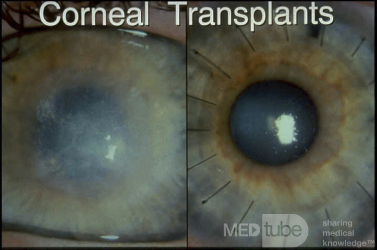Przed i po transplantacji rogówki