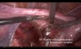 Zabieg laparoskopowy u pacjentki z mięśniakiem wrastającym pomiędzy blaszki więzadła szerokiego macicy