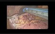 Laparoskopowa resekcja krwawiącego GISTu jelita cienkiego