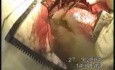 Operacja raka przełyku