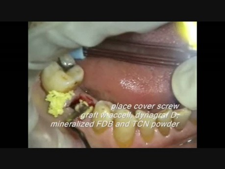 Mikrochirurgia implantologiczna: zastąpienie przetrwałego mlecznego trzonowca