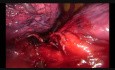 Wideotrakoskopowe usunięcie płata dolnego płuca lewego z pojedynczego podżebrowego cięcia