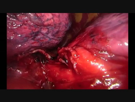 Wideotrakoskopowe usunięcie płata dolnego płuca lewego z pojedynczego podżebrowego cięcia