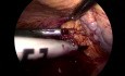 Réparation Laparoscopique d'une Volumineuse Hernie Diaphragmatique Droite