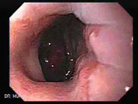 Rak żołądka we wczesnym stadium - endoskopia (3 z 21)