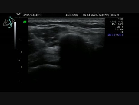 Ultrasonografia interwencyjna: Iniekcje dostawowe pod kontrolą USG 28-29 marzec