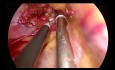 Resekcja guza neurogennego górnego otworu klatki piersiowej metodą uniportal VATS