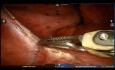 Sekwestracja płuca - operacja z użyciem robota