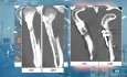 Wyniki osteosyntezy w okolicy wyrostka kłykciowego żuchwy.