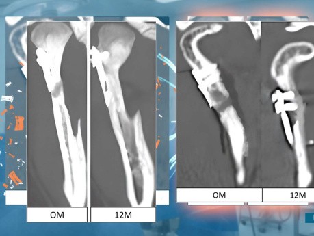 Wyniki osteosyntezy w okolicy wyrostka kłykciowego żuchwy.