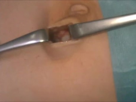 Endoskopowa całkowicie zewnątrzotrzewnowa operacja naprawcza przepukliny pachwinowej