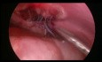 Laparoskopowa operacja przepukliny przymostkowej (przepuklina Morgagniego)