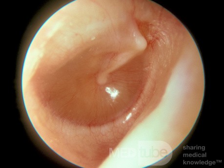 Śluzowe zapalenie ucha środkowego 