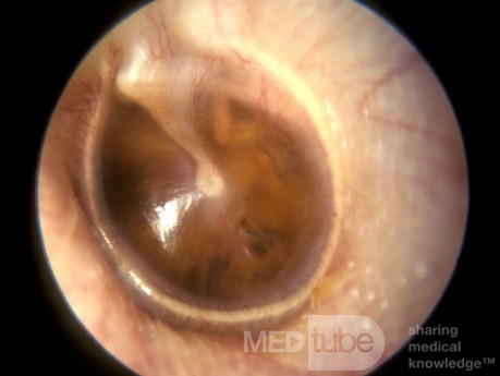Surowiczego zapalanie ucha środkowego u dorosłego