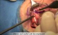 Chirurgiczna dekompresja oczodołu w chorobie Gravesa-Basedowa
