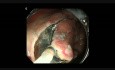 Hybrydowa endoskopowa dyssekcja podśluzówkowa raka żołądka