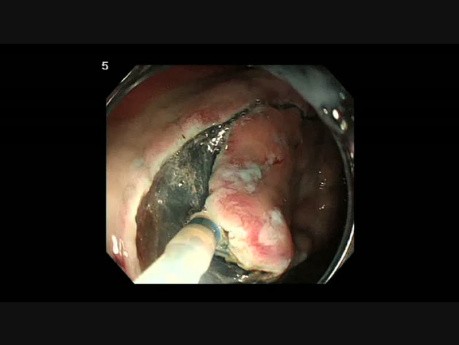 Hybrydowa endoskopowa dyssekcja podśluzówkowa raka żołądka