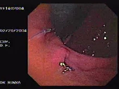 Endoskopowe szycie wewnątrz światła - obraz dwóch guzków w inwersji endoskopowej, część 2