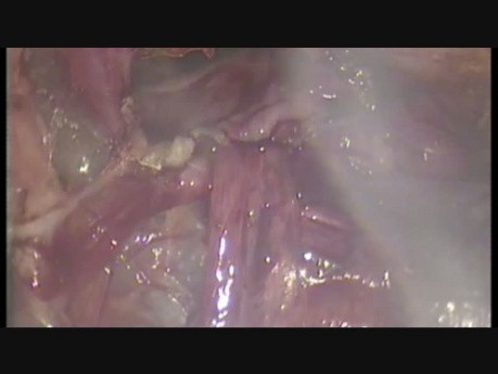 Laparoskopowa operacja nawrotowej wrodzonej przepukliny pachwinowej
