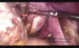 Bezkrwawa laparoskopowa polimiomektomia