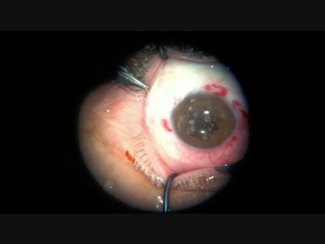 One Day with Iris Plastic Surgery. Posttraumatic, Postsurgical, Postinflammatory and Congenital Reasons of this Repair will be Presented