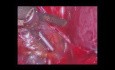 Histerektomia laparoskopowa