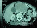wrzód żołądka, wrzody żołądka z przetoką żołądkowo-okrężniczą z powodu zespółu Zollingera-Ellisona (29 z 33)