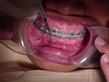 Pacjent Ortodontyczny RM - 7 miesięcy