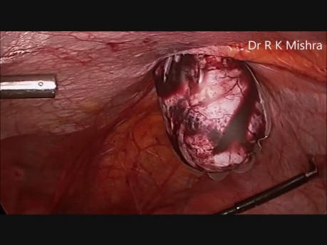 Pobieranie tkanek przy laparoskopii 
