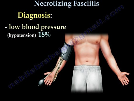 Necrotizing Fasciitis - Nekrotyczne zapalenie powięzi