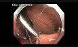Kolonoskopia: opóźnione krwawienie po wykonanej endoskopowej resekcji śluzówkowej dużego polipa odbytnicy