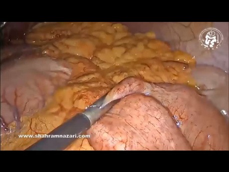 Bypass jednoanastomozowy żołądka jako reoperacja po nieudanej rękawowej resekcji żołądka