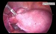 Całkowita laparoskopowa histerektomia z zastosowaniem trzech portów i podczerwonego cewnika moczowodowego 