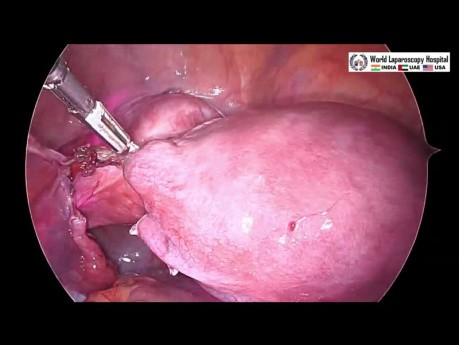 Całkowita laparoskopowa histerektomia z zastosowaniem trzech portów i podczerwonego cewnika moczowodowego 