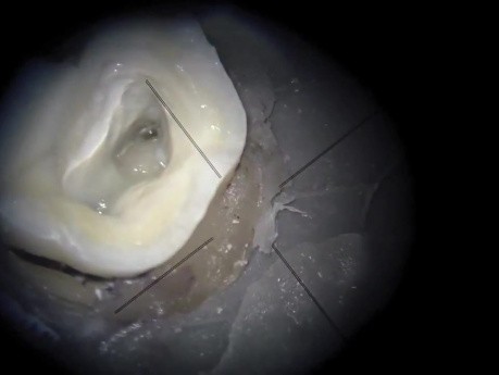 Dostęp endodontyczny do górnego trzonowca – wykorzystanie mikroskopu i ultradźwięków do odnalezienia kanału MB2