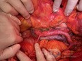 Prawa tętnica nerkowa przebiegająca przed żyłą główną dolną podczas limfadenektomi z powodu raka endomterium 