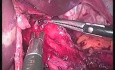 Kardiomiotomia z przednią fundoplikacją  - SILS