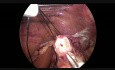 Laparoskopowe wycięcie mięśniaka dystalnej części przełyku, fundoplikacja Nissena
