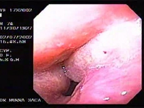 Obszerny rak krtani - obraz endoskopowy