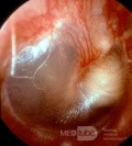 Wrodzona torbiel epidermalna w uchu środkowym