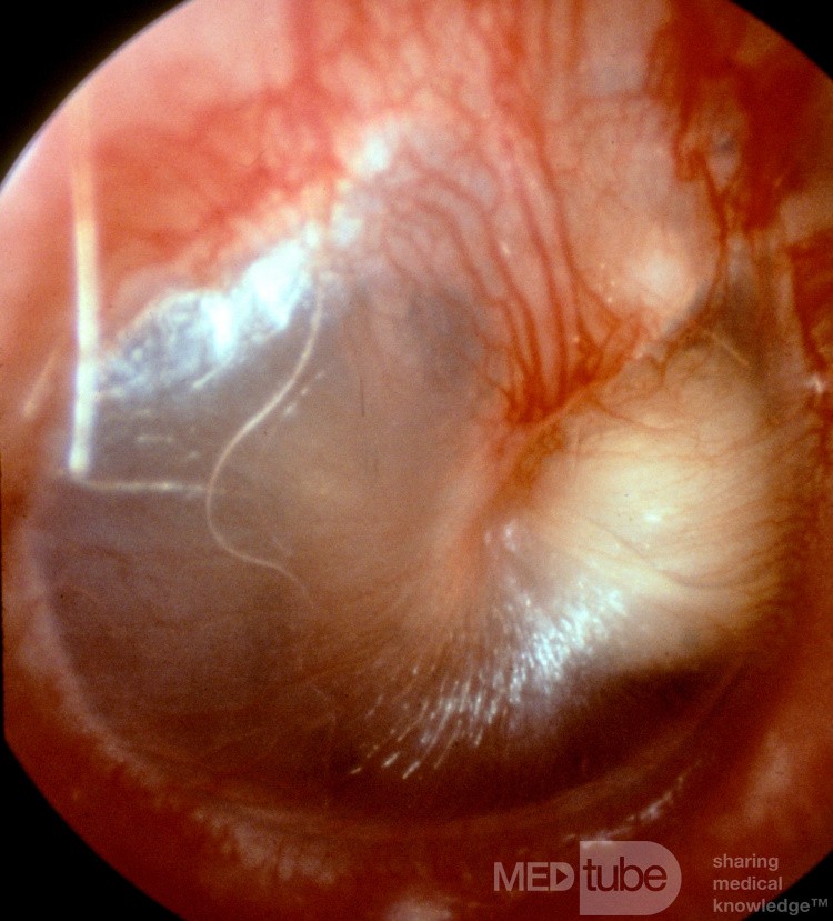 Wrodzona torbiel epidermalna w uchu środkowym