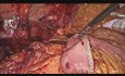 Laparoskopowa hepatojunostomia dla jatrogennego uszkodzenia przewodu żółciowego