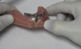 Proteza dolna oparta na implantach - model