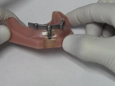 Proteza dolna oparta na implantach - model