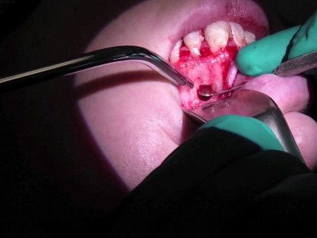Chirurgia Kanałowa (Apikoektomia - resekcja wierzchołka korzenia zębowego #10) Część 2/2