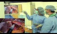 Edukacja rezydentów w zakresie laparo-endoskopowej jednomiejscowej (LESS) fundoplikacji sposobem Toupeta