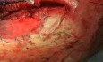 Aplikacja kropla po kropli Glubranu 2 jako szczeliwa w chirurgii plastycznej opony twardej