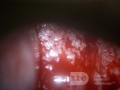 Rak gruczołowy szyjki macicy (Carcinoma Glandulare Colli Uteri)