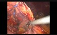 Laparoskopowa dystalna resekcja trzustki ze splenektomią