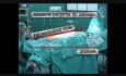 Ułożenie pacjenta - laparoskopowa radykalna prostatektomia